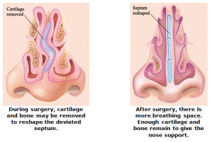 septoplasty